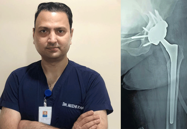 डा निशिकांत ने किया बिहार में पहली बार  कस्टमाइज़्ड कूल्हा प्रत्यारोपण